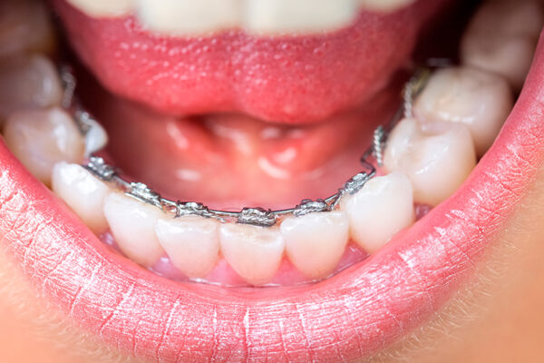 Головні показання для встановлення брекет-системи