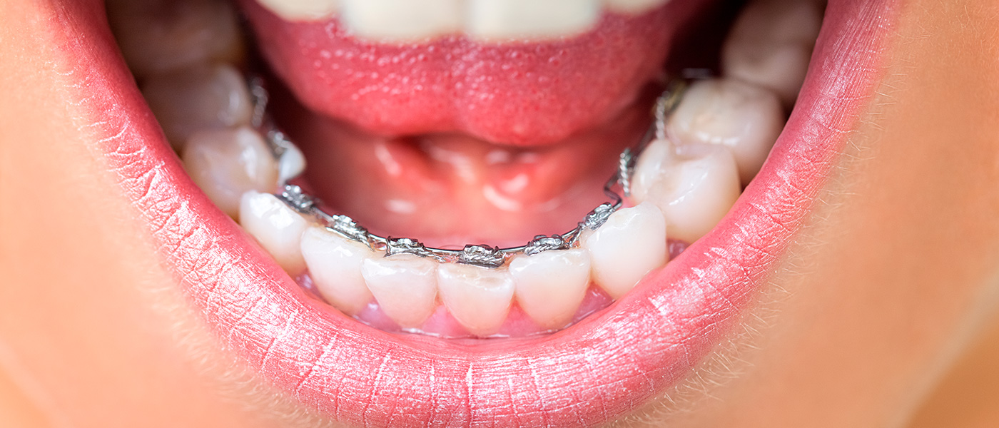 Головні показання для встановлення брекет-системи